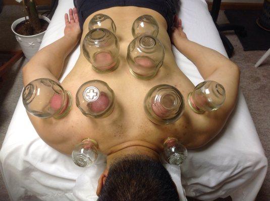 Cupping