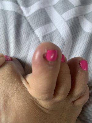 Toe