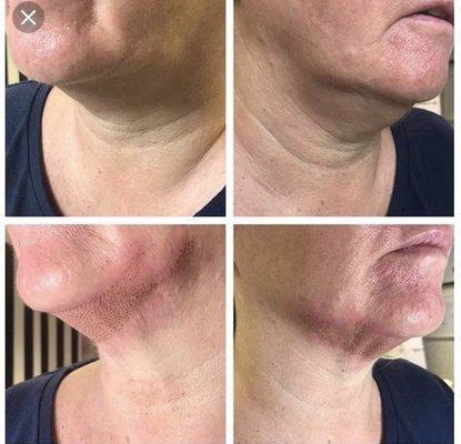 Neck lift