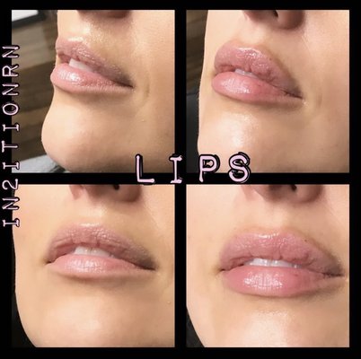 Beautiful lip filler injections