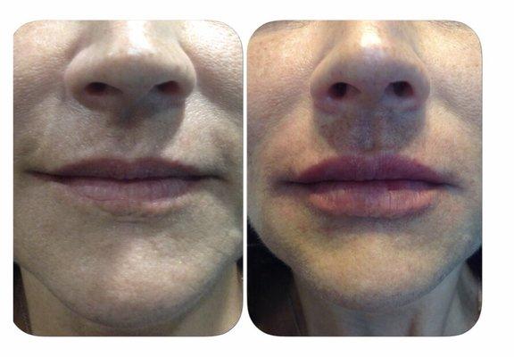 Wanted a fuller but natural looking lip to fill in the scar from childhood. Thanks Brianne