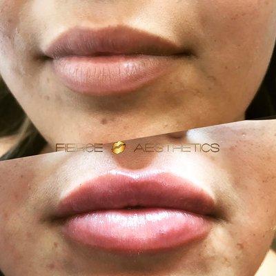 Lip Enhancement