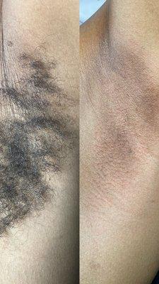 Before and after Underarm wax.