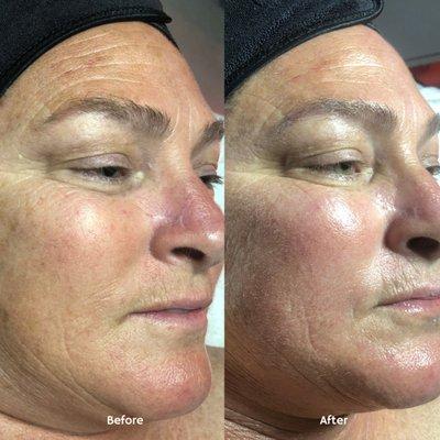 Signature Facelift Facial