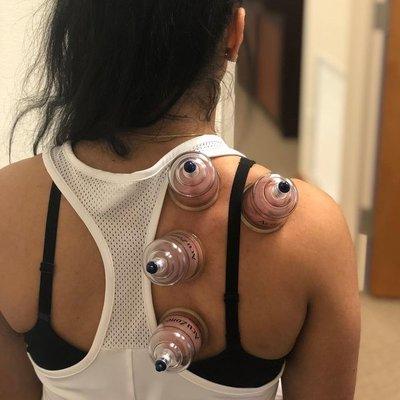 Cupping is a form of ancient medicine that has been used for over a thousand years by Chinese, Egyptian, and other Eastern cultures.