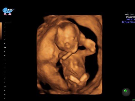 3D of baby in 2nd trimester