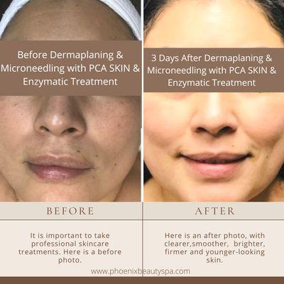 Microneedling with Enzymatic Treatment - truly results-driven! The amazing result is from receiving one-time treatment only. Book now!