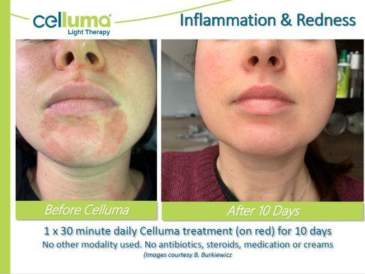 Before/After Celluma LED Red Light Therapy Treatment for redness & inflammation. No other treatments used.