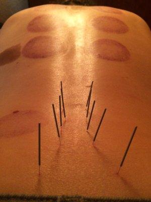 Acupuncture after cupping