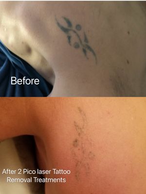 After 2 Pico Laser Tattoo Removal