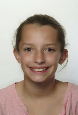 Teen Orthodontics; Before