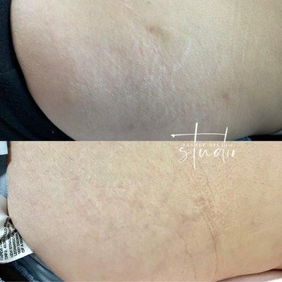 Stretch Mark Treatment