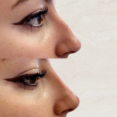 Nonsurgical Rhinoplasty