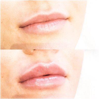 Lip Filler before & after