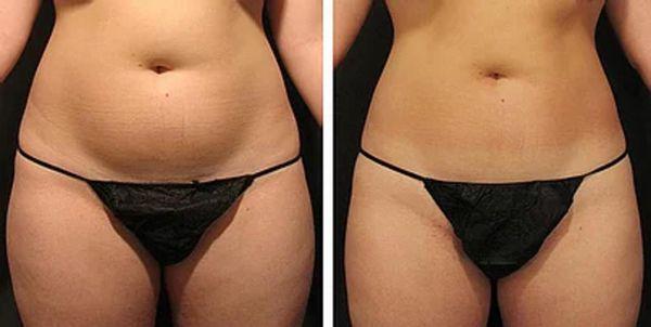 Before and After Female Slimming Session With 3D Lipo