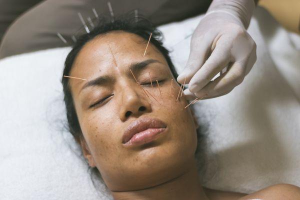 Facial Acupuncture