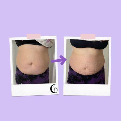 Before and after results of our new MesoTherapy service (fat dissolvers).