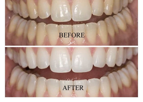 Teeth whitening $80