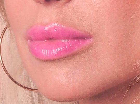 Juvederm Enhanced lips