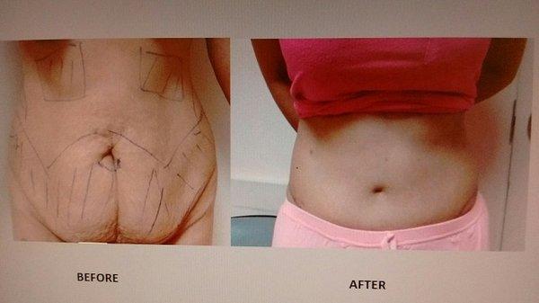 NUC PLASTICS FULL TUMMY TUCK