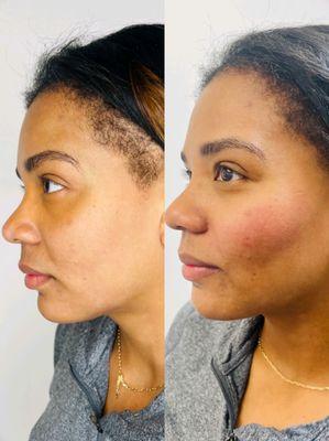 Cheek pop for this beauty using Restylane Lyft.