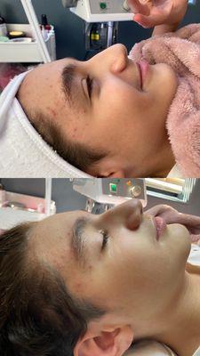 Acne reducing facial