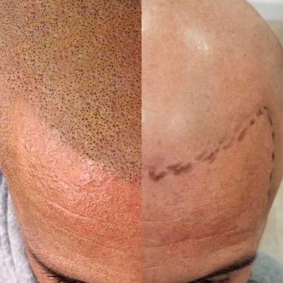 Scalp Micropigmentation Miami