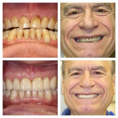 Before and After of 72 year old male who was seeking a smile makeover after years of stress, stain, and wear on his teeth.