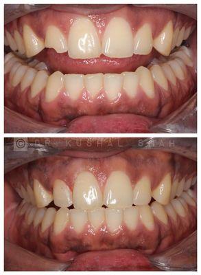 Veneer for a fractured tooth