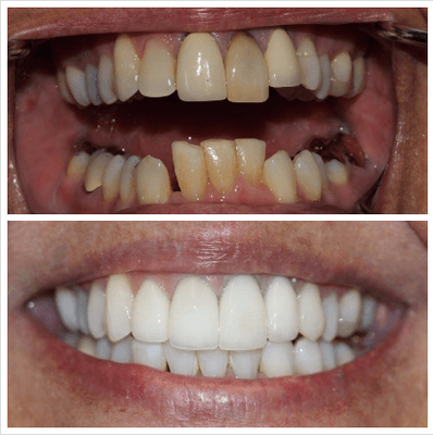 Smile transformation using Invisalign, whitening, and finished with Porcelain crowns.