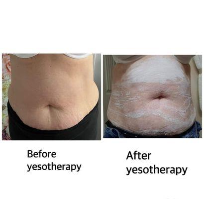 Yeso therapy is a treatment for fat loss tightening the skin and losing bloat it can be worn for up to 8 hrs and hardens like a cast