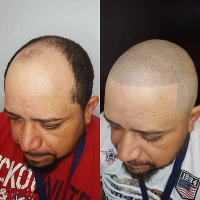 Scalp Micropigmentation Treatment