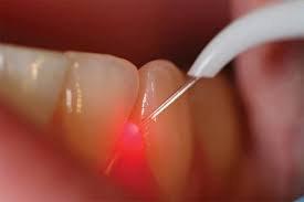 Non-surgical laser gum surgery