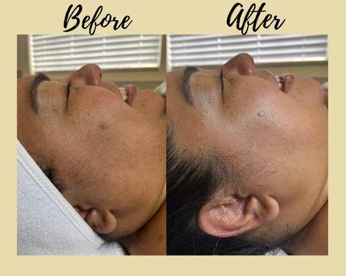 Microdermabrasion Before and After