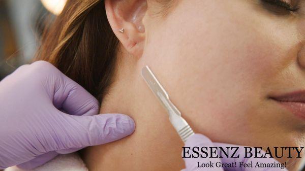 Dermaplaning