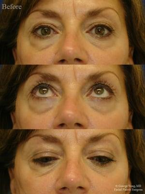 55 yo woman: Restylane injections to blend away her eyebags by filling her tear troughs & orbital rim hollow and lift her cheek.