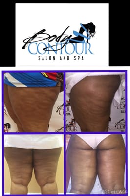 Before and After  Body Contour Cellulite Treatment  Call: 7862547972  for your free consultation