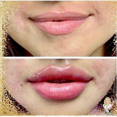 Lisa Topham RN BSN's Before & After Lip Transformation | Split Rock Aesthetic Institute