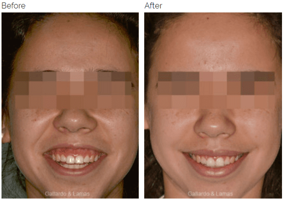 Before and after Lip Repositioning to improve the appearance of gummy smile.