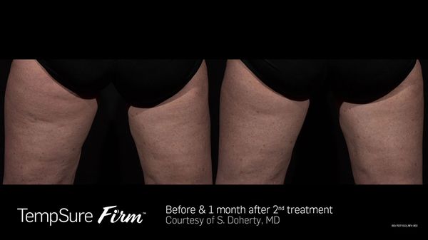 Tempsure helps reduce cellulite as shown with these before and after pictures