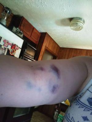 1st day of bruising. It got much worse!