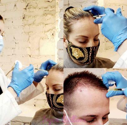 PRP Hair Restoration
 @rejuvenationbyirina