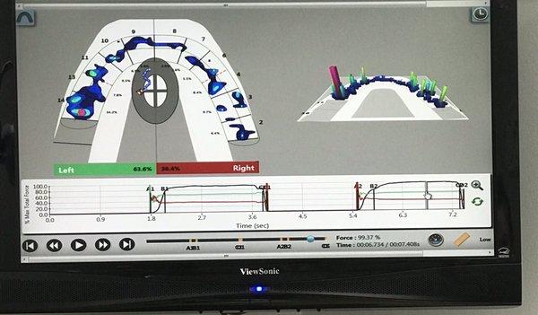 Bite mapping technology.