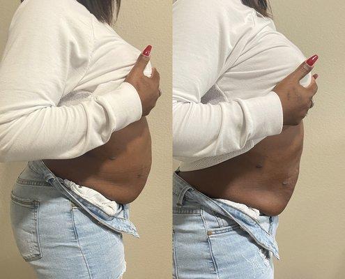 Laser Lipo - 2.5 in loss