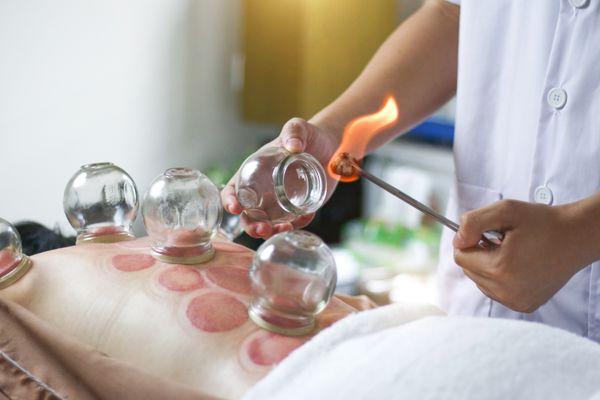 Hot Cupping- Traditional Chinese Medicine Treatment.  Call our spa @310-869-9437 for appointment with Dr.Sun