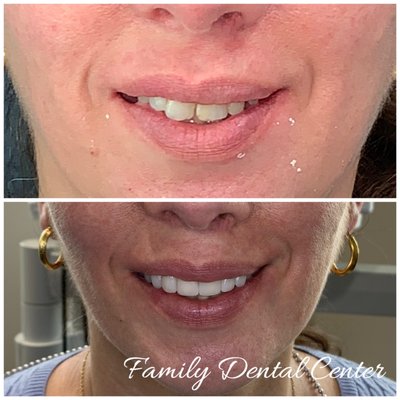 Smile design before and after. Shape, color and position of teeth were improved to improve facial esthetics.