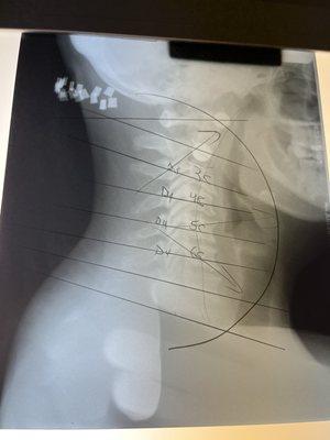 Neck vertebrae is reversed with 2 damaged vertebrae's