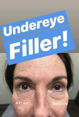 Before & After of Undereye Filler administered by Dr. Bo using Juvederm Volbella®! Amazing results between the 2 eyes!