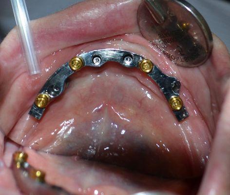 Implant retained dentures are an affordable alternative to complete fixed dental implants