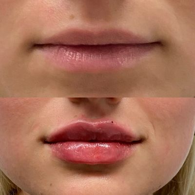 Lip filler